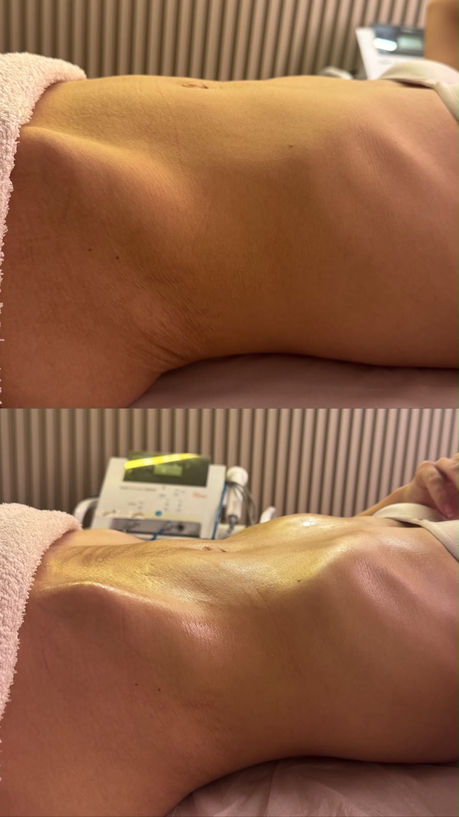 Comparativo fotográfico de atendimento corporal, visto de perfil